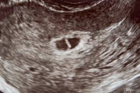 Losing Our Baby Ivf Miscarriage The Diy Playbook