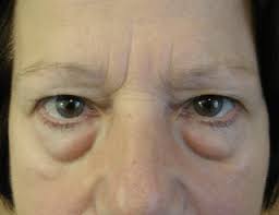 Before and After Photos of Surgery by Mr Richard Caesar