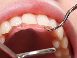 13 Obat Gusi Bengkak Alami Agar Cepat Kempes Disertai Penyebab