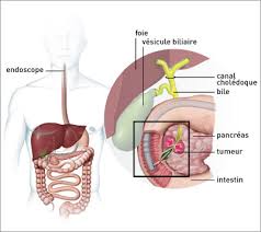 The earliest stage pancreas cancers are stage 0 (carcinoma in situ), and then range from stages i (1) through iv (4). Protheses Biliaires Ou Duodenales Cancer Du Pancreas