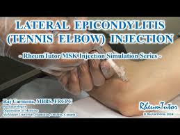 Image result for Epicondyle Injection