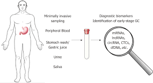 Almost 90% of cancers are adenocarciomas sometimes the symptoms of stomach cancer in the early stages present themselves in the form of polyps and gastritis, that is, precancerous diseases. Recent Advances In Gastric Cancer Early Diagnosis