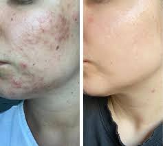 If you can, i think it would be ideal to go to a dermatologist and see what they say. Reddit Salicylic Acid Promotion Off 64