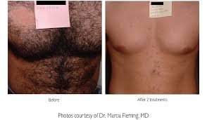 The key reason that grey, white, and light blonde hair are difficult to remove with laser and ipl hair removal technology is because of the method. Tired Of Being Lied To About Laser Hair Removal Lougheed Laser Blog
