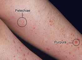 Symptoms of diabetes mellitus diabetes affect disease lupus skin disorders lupus body affects of diabetes thyroid and diabetes rash vector amyloidosis autoimmune diseases. Petechiae And Purpura Flashcards Quizlet