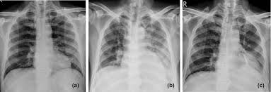 Potential mechanisms of fluid increased interstitial fluid in the heart failure is by far the most common cause of bilateral pleural effusion, but if cardiomegaly is not present, other causes such as malignancy. Acute Myeloid Leukemia With Leukemic Pleural Effusion And High Levels Of Pleural Adenosine Deaminase A Case Report And Review Of Literature