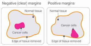These contrast with benign tumors, which do not spread. Surgery To Treat Breast Cancer