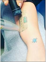 A local anaesthetic is usually administered as this is a painful method of removal. Video Laser Tattoo Removal Services In Los Angeles Ca Tattoo Removal Before And After