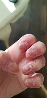 Winterhanden Misvormde Nagels Bokt Nl