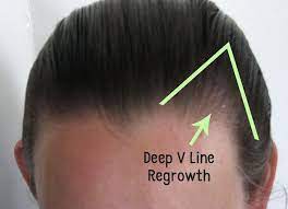 This Hair Loss Success Story Is From A Woman Who Reversed Her Receding Hairline Using A Simple Tool Hair Brus Regrow Hair Regrow Hair Women Frontal Hair Loss