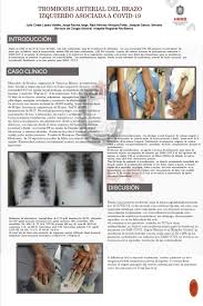 Hacer los ejercicios que le indique su médico. Pdf Trombosis Arterial Del Brazo Izquierdo Asociada A Covid 19