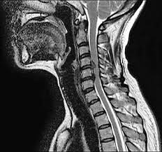 Symptoms of a herniated disc in the neck neck pain is the obvious sign of a herniated disc, but it can be accompanied by other symptoms, including: Cervical Herniated Disc Kaizo Health Safe Pain Relief