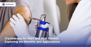 Image result for Cryotherapy