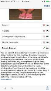 Requested Docalert Picture Quiz Poll A Kindergarten Girl With Bowed Legs Asociacion De Medicina Interna De El Salvador