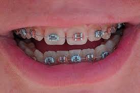 Orthodontic wax is usually sold to keep braces from poking into lips and gums. Pin By Ava On Cute Braces Colors Dental Braces Colors Braces Tips Braces Colors