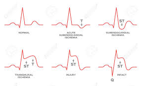 An nstemi differs from a stemi, which is the most common type of heart attack, by causing less damage to a. Diagnosis Myocardial Ischemia Vector Nstemi Stemi Royalty Free Cliparts Vectors And Stock Illustration Image 110606838