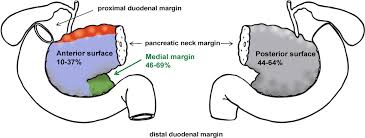 The worldwide introduction of total mesorectal excision in combination with the one of the main prognostic factors in rectal cancer is the circumferential resection margin (crm). Cancers Free Full Text Definition Of Microscopic Tumor Clearance R0 In Pancreatic Cancer Resections