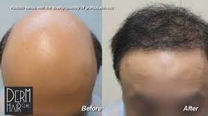 Remember there are normally 2 hairs in each hair graft. Hair Transplant Graft Count How Many Grafts Do I Need