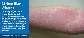 The most common causes are foods, medications, and infections. All About Hives Urticiaria Pediatric Affiliates Of Hampton Roads
