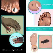 Image result for Acral lentiginous melanoma nail