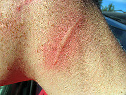 Image result for Dermatographism