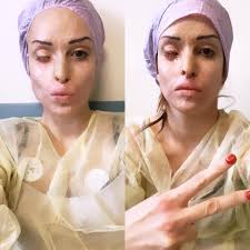 How tall and how much weigh gessica notaro? Gessica Notaro Terminata L Operazione All Occhio I Medici Soddisfatti Valuteremo Trapianto Di Cornea Open