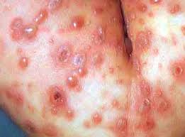 Ini merupakan jenis penyakit kulit yang cukup sering terjadi karena sekitar 80% orang pernah mengalaminya. 30 Jenis Penyakit Menular Penyebab Dan Pencegahannya