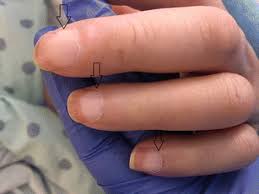 Chronic kidney disease may not become apparent until your kidney function is significantly impaired. Terry S Nails And Lindsay S Nails Two Nail Abnormalities In Chronic Systemic Diseases Springerlink