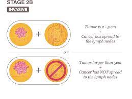 Generally, the higher the number and letter,. Stage 2 Ii And Stage 2a Iia National Breast Cancer Foundation