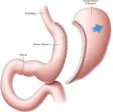 Gastric Sleeve Surgery In Delhi Sleeve Gastrectomy Vertical Sleeve Gastrectomy Sleeve Surgery