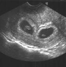 Early twin ultrasound at 7 weeks. Transvaginal Ultrasound Demonstrating Viability Of Twin Pregnancy At 8 Download Scientific Diagram