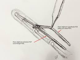 More on that in a minute. Flexor Tendons Of The Finger With Pulleys Removed James Henderson Specialist Plastic Hand Surgeon