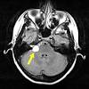 It is the most common cause of spontaneous. 1