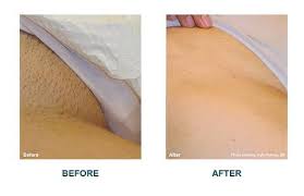 Results may vary from person to person. Paperback Play Sports Studio Pubic Laser Hair Removal Before And After Jungodaily Com