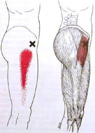 Know Your Trigger Point Muscle Series Tensor Fasciae Latae Roman Paradigm Massage Therapy Llc Massage Therapy Trigger Points Trigger Point Therapy