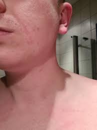 Was Konnte Diesen Hautausschlag Im Gesicht Verursachen Gesundheit Und Medizin Haut
