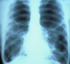 While it's true that 90 percent of lung cancer cases are smoking related, 10 percent come from other causes, and that number is even higher in utah at 30 percent. Lung Cancer Cases On The Rise In Non Smokers Study Suggests Live Science
