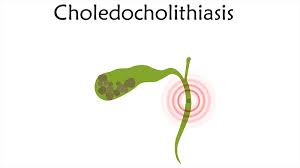 Image result for Choledocholithiasis