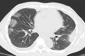 Patients with pneumonia have a poorer it requires a suitably trained and competent user to be safe and effective. Epos Trade