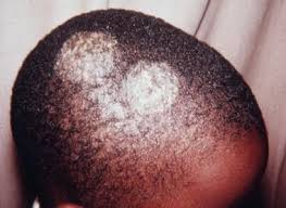My doctor said rudolphs hair loss was caused by ringworm. Tinea Capitis Background Pathophysiology Etiology