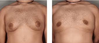 Going For Gynecomastia Surgery 3 Tips Can Improve Results