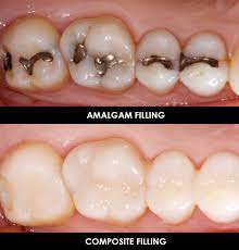 Amalgam Or Composite Fillings Which One Do I Want Blog Community Dental Assisting Dental Fillings Dental Restorative Dentistry