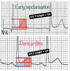 Image result for Early Repolarization