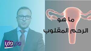 ما هو الرحم المقلوب وهل يحتاج إلى علاج youtube