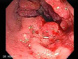 Pancreatic cancer often causes symptoms in the patient's digestive tract. Rectal Cancer And Internal Hemorrhoids Youtube
