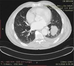 A pleural effusion is accumulation of excessive fluid in the pleural space, the potential space that surrounds each lung. Pleural Effusions In Lung Cancer Detection And Treatment Intechopen
