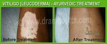Vitiligo Treatment Best Ayurvedic Skin Treatment In India
