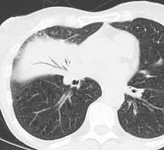 Image result for Air Bronchogram