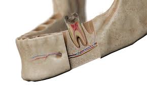 Image result for Pulpitis