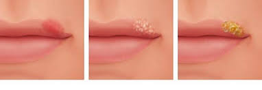 Herpes simplex i löst das lippenherpes aus, herpes simplex ii ist für genitalherpes verantwortlich. Lippenherpes Gesundheitsinformation De